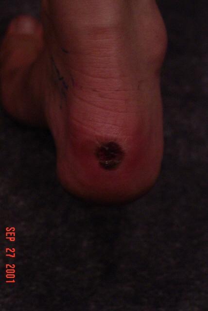 Kayte's heel after hiking close up.JPG